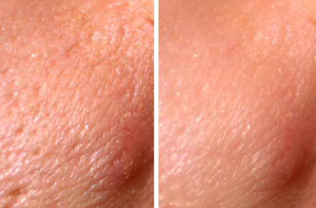 before and after laser resurfacing