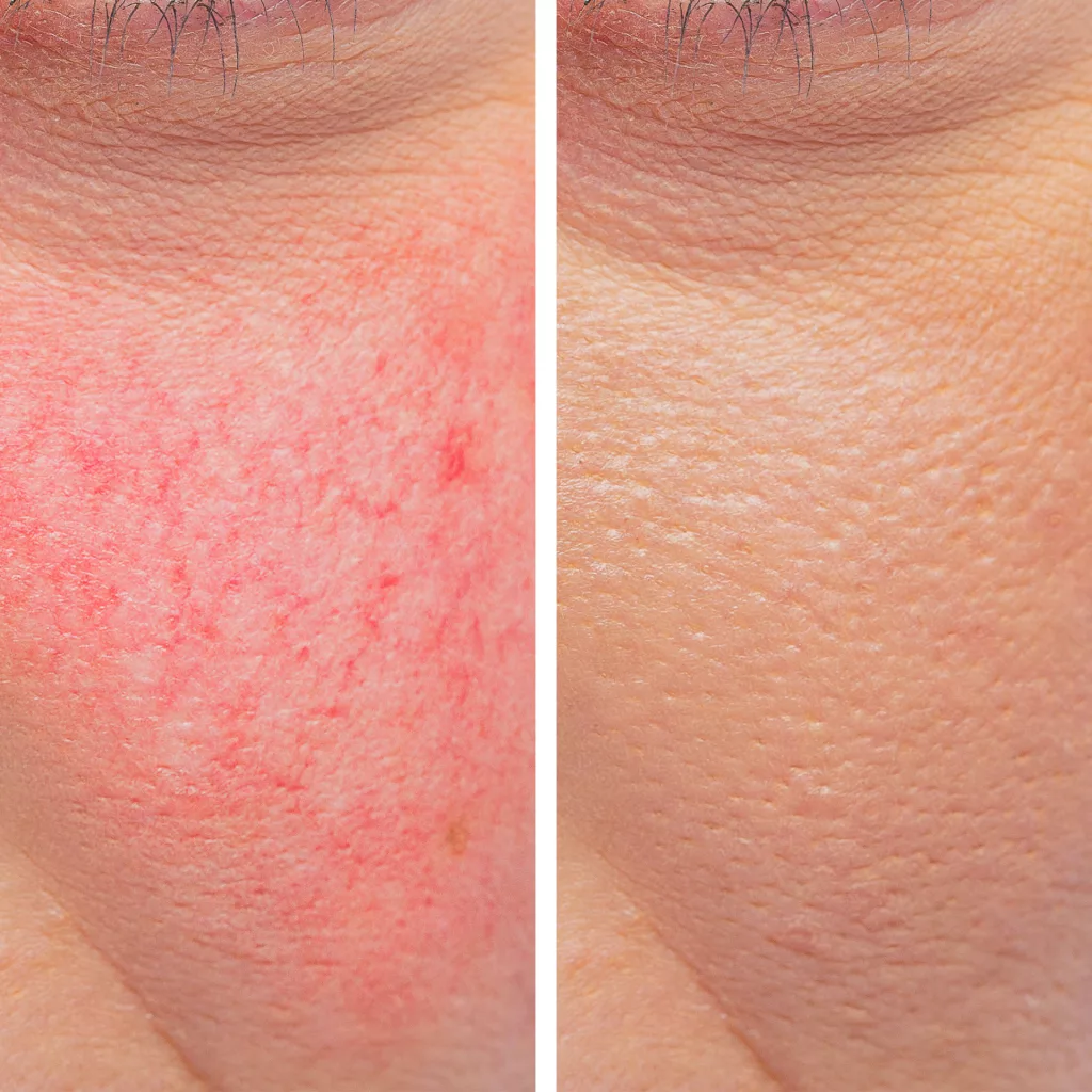before and after laser spider vein treatment