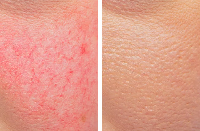 before and after laser spider vein treatment