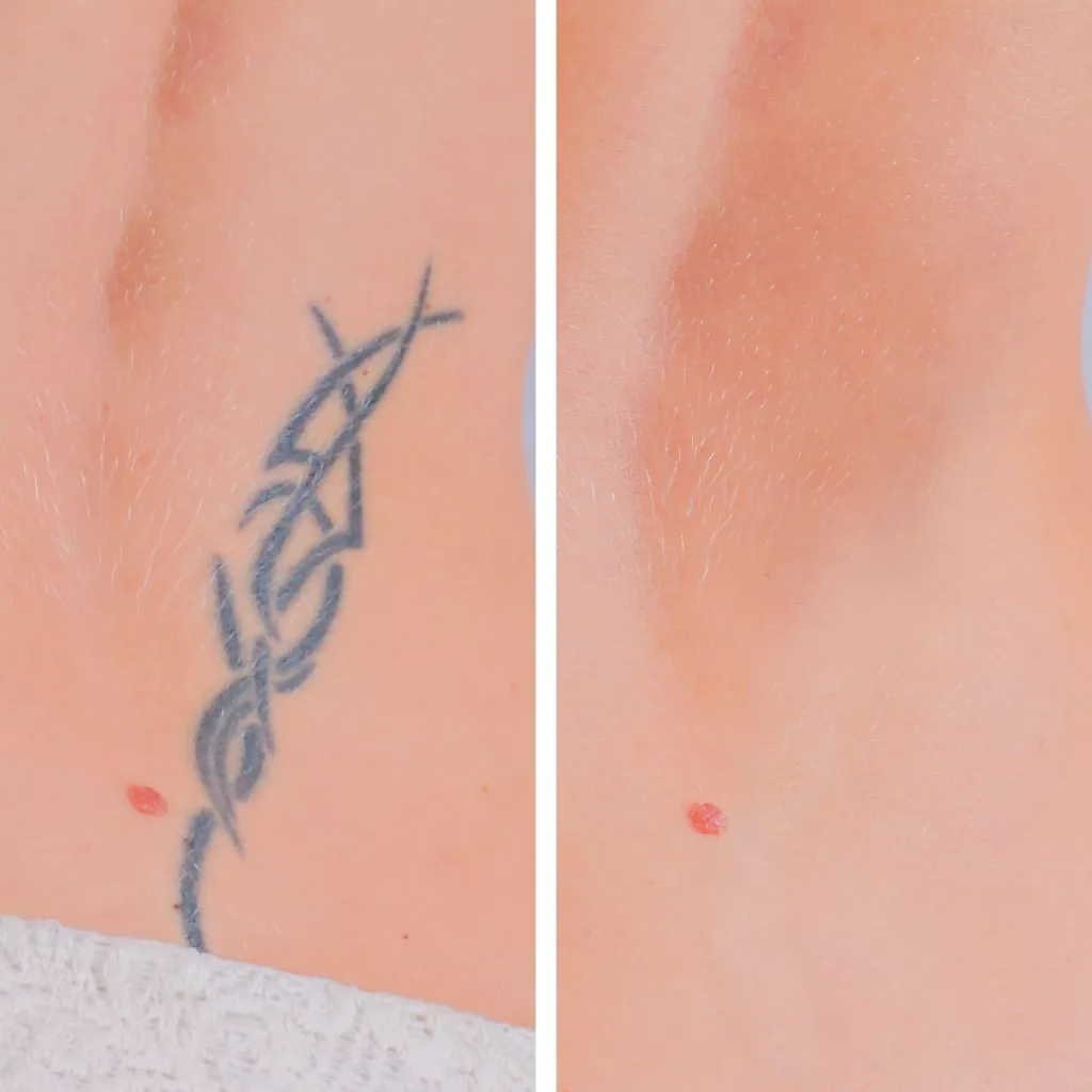 before and after laser tattoo removal