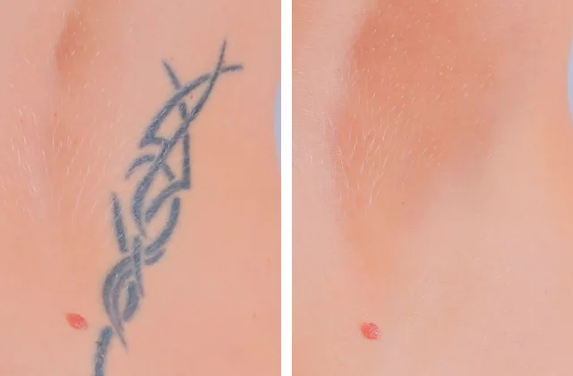 before and after laser tattoo removal