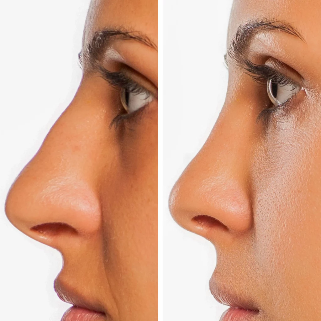 before and after liquid rhinoplasty