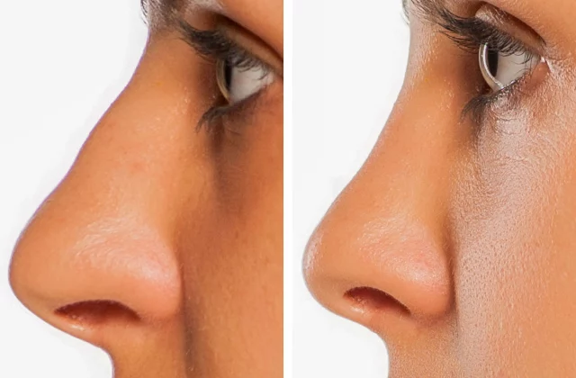 before and after liquid rhinoplasty