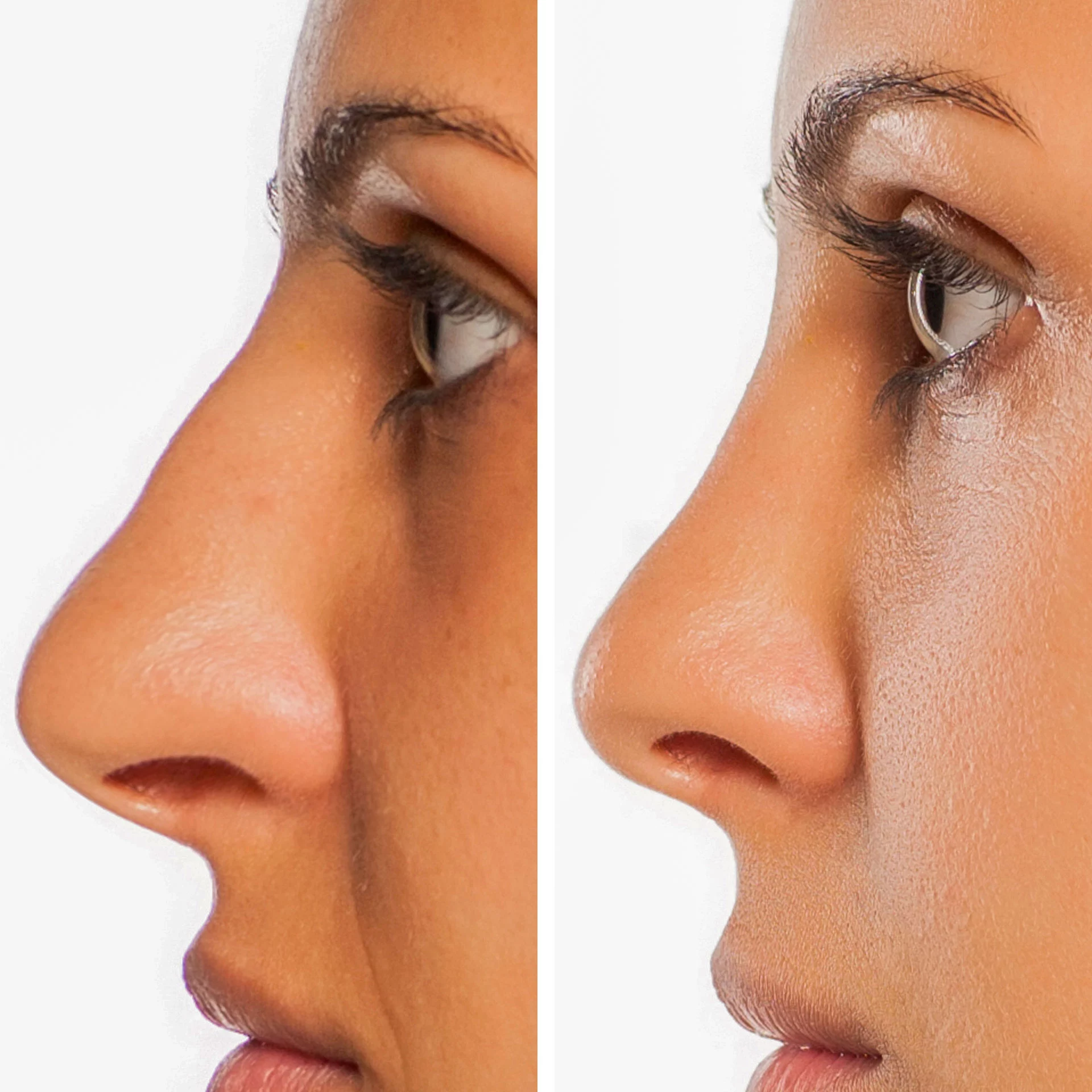 Rhinoplasty