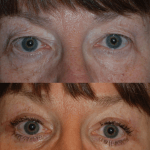 close up of woman's eyes before and after eyelid surgery