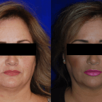 woman's face before and after botox