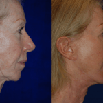 side profile of woman's face before and after botox