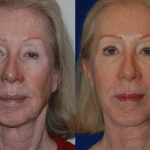 woman's face before and after Botox