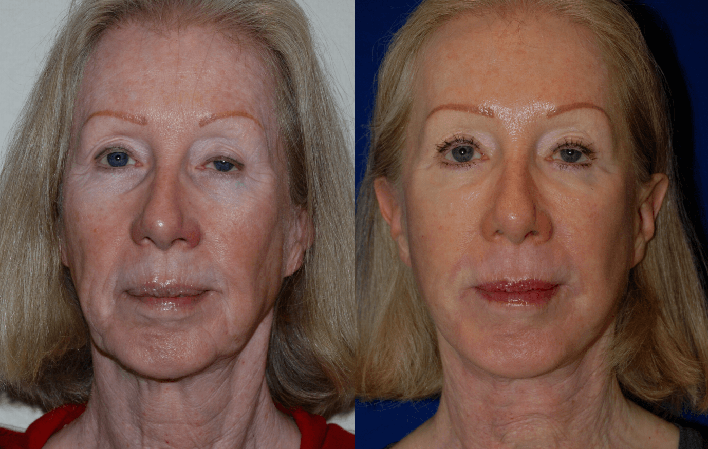 woman's face before and after Botox