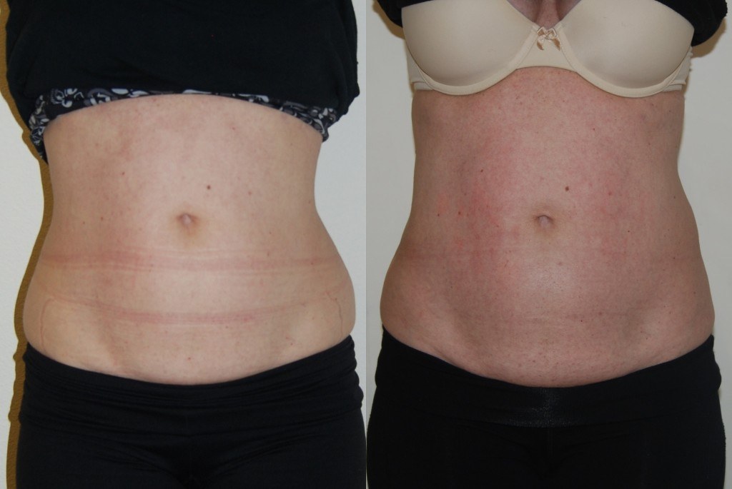 woman's abdomen before and after Coolsculpting