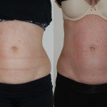 woman's abdomen before and after Coolsculpting