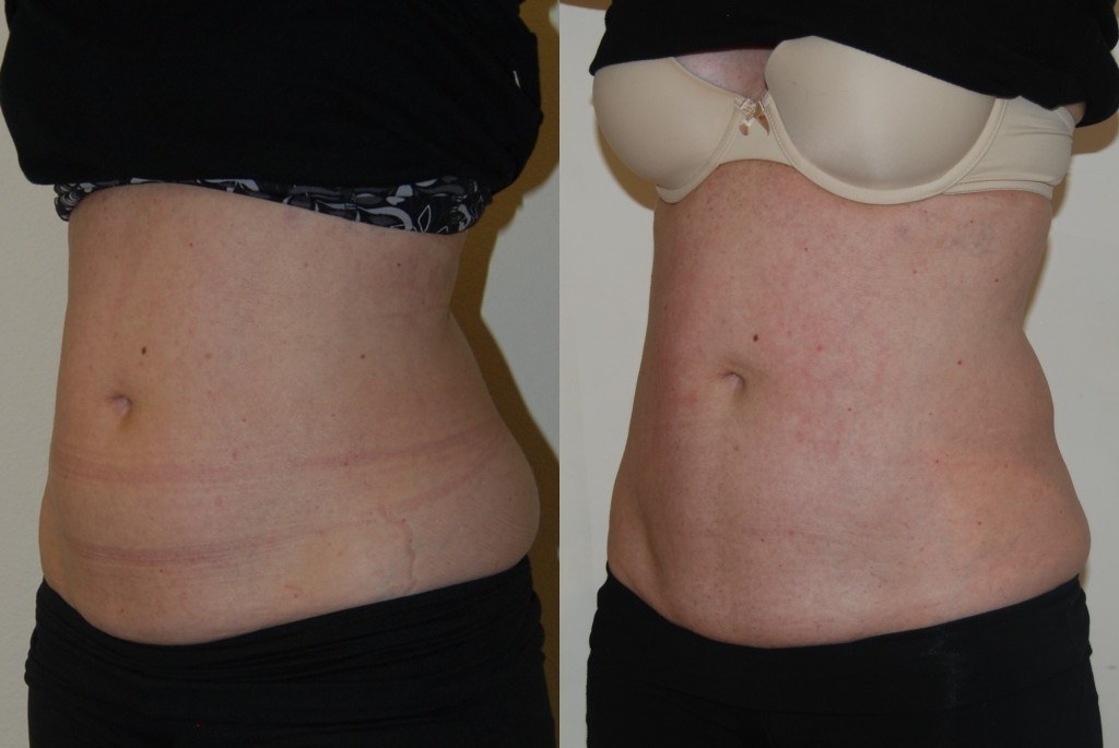 woman's abdomen before and after Coolsculpting