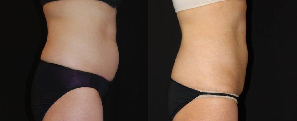 coolsculpting before and after