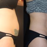woman's abdomen before and after CoolSculpting to reduce fat and improve body contour