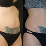 woman's abdomen before and after CoolSculpting to reduce fat and improve body contour