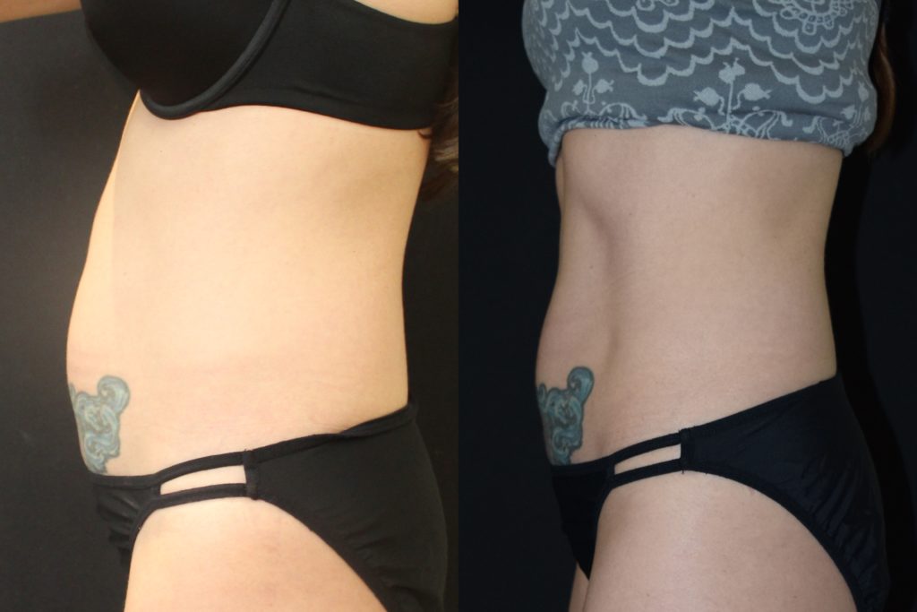 before and after coolsculpting photos of abdomen