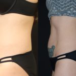 woman's abdomen before and after CoolSculpting to reduce fat and improve body contour