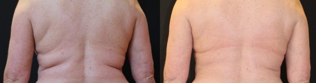 Before and after woman's CoolSculpting treatment to reduce fat and encourage muscle growth