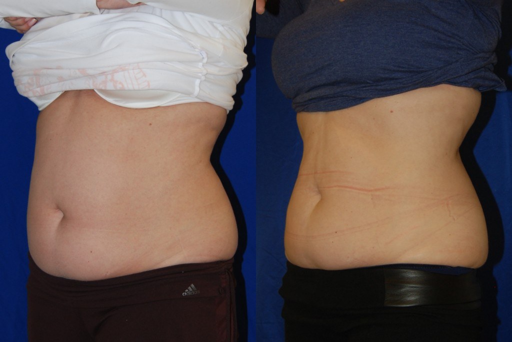 coolsculpting before and after