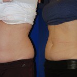 coolsculpting before and after