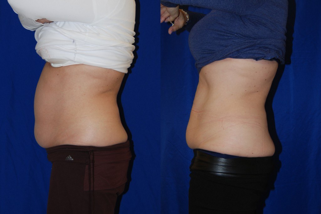 coolsculpting before and after