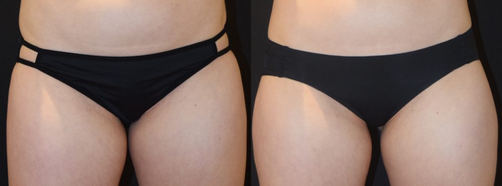coolsculpting before and after photo of woman's inner thighs