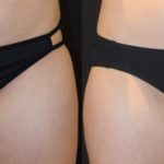 coolsculpting before and after photo of woman's inner thighs