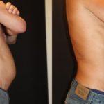 Before and after man's CoolSculpting treatment to reduce fat and encourage muscle growth