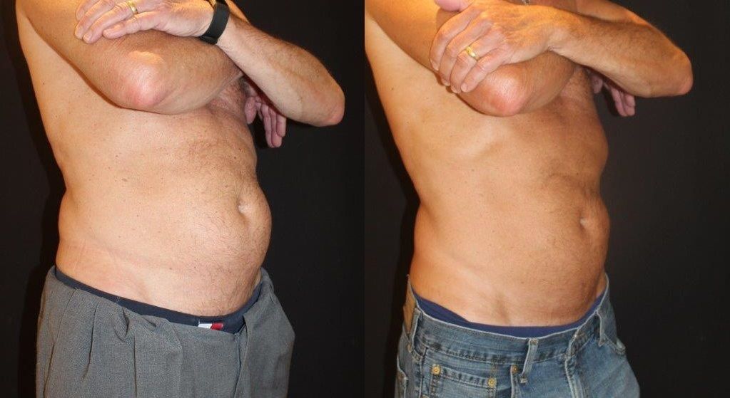 coolsculpting before and after