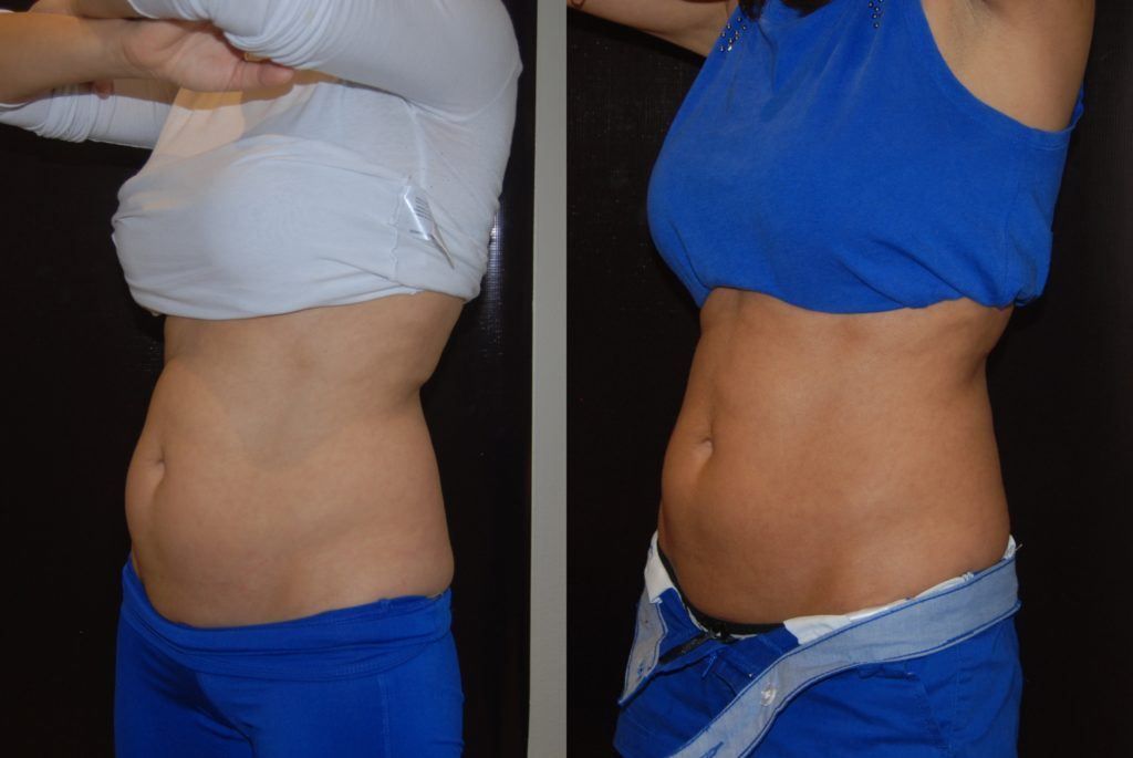 woman's abdomen before and after Coolsculpting showing reduced fat