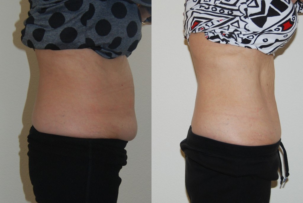 woman's abdomen before and after coolsculpting