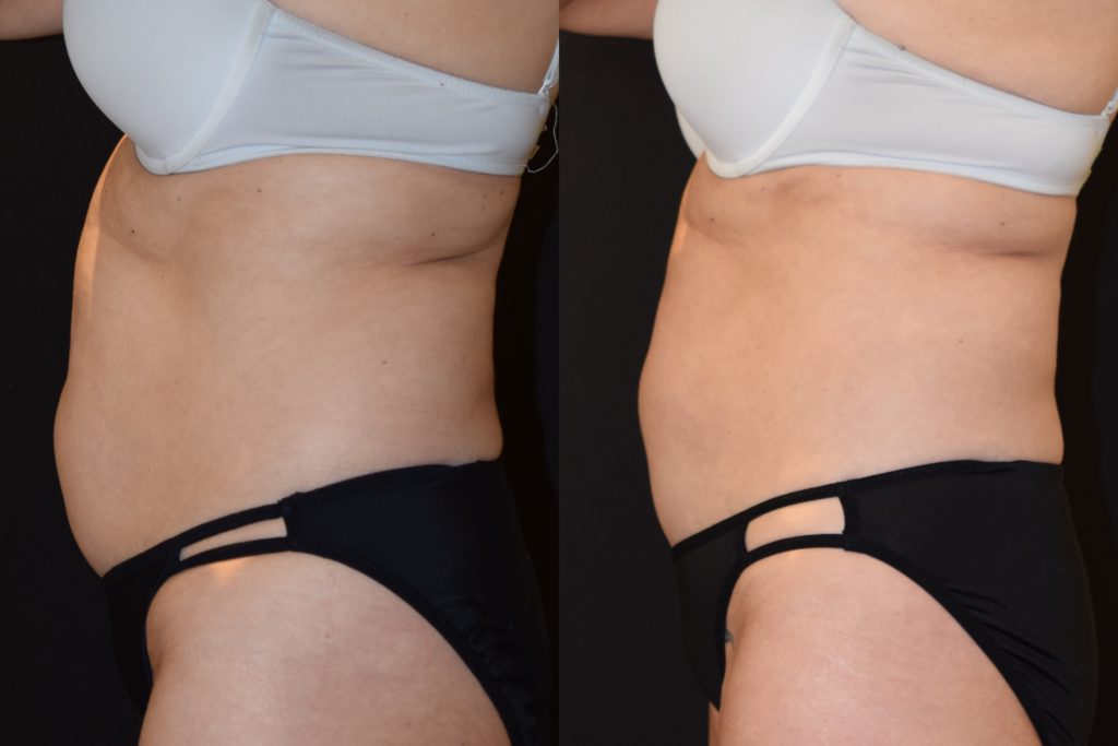 woman's abdomen before and after CoolSculpting to reduce fat and improve body contour