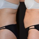 woman's abdomen before and after CoolSculpting to reduce fat and improve body contour