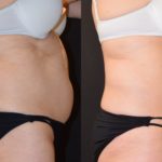 woman's abdomen before and after CoolSculpting to reduce fat and improve body contour