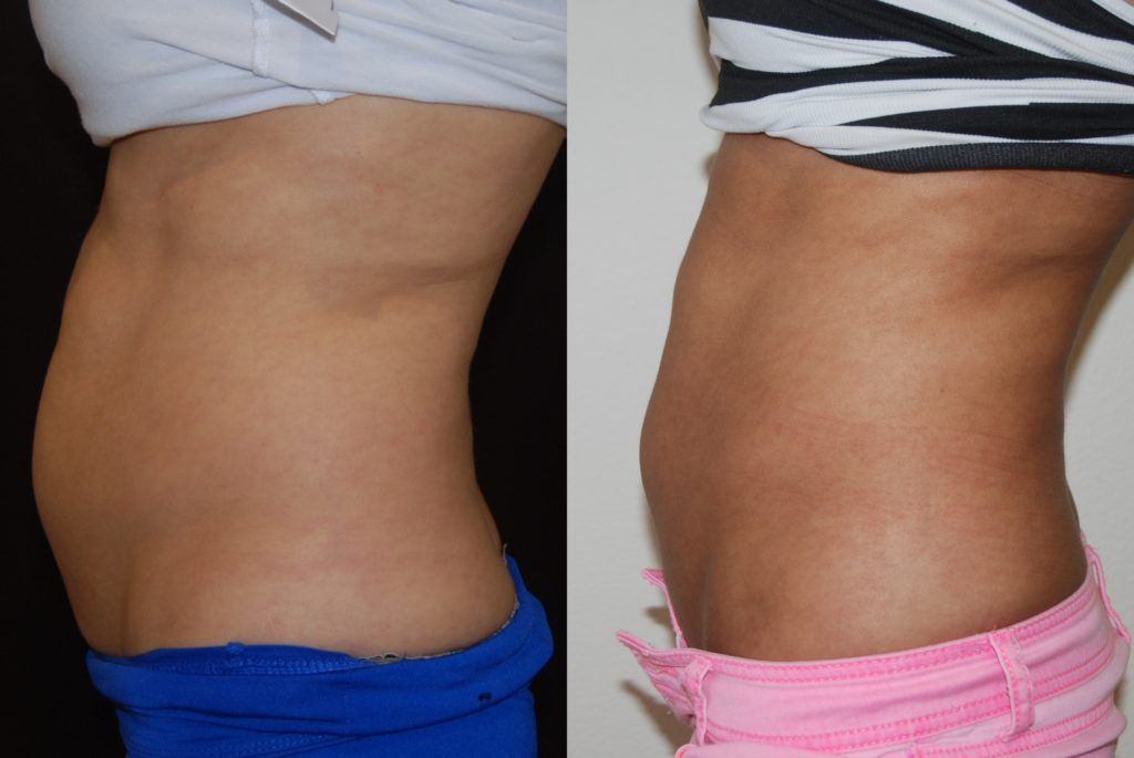 side profile of woman after Coolsculpting Treatment showing reduced belly fat