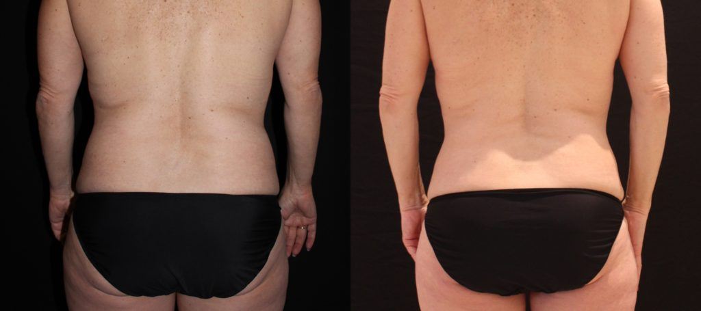 coolsculpting before and after