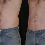 coolsculpting before and after stomach area