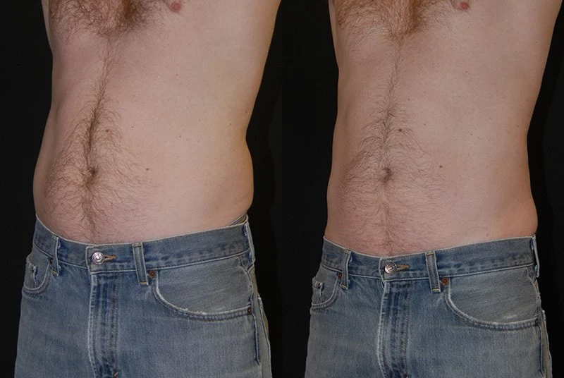 coolsculpting before and after stomach area