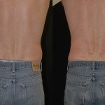 coolsculpting before and after lower back