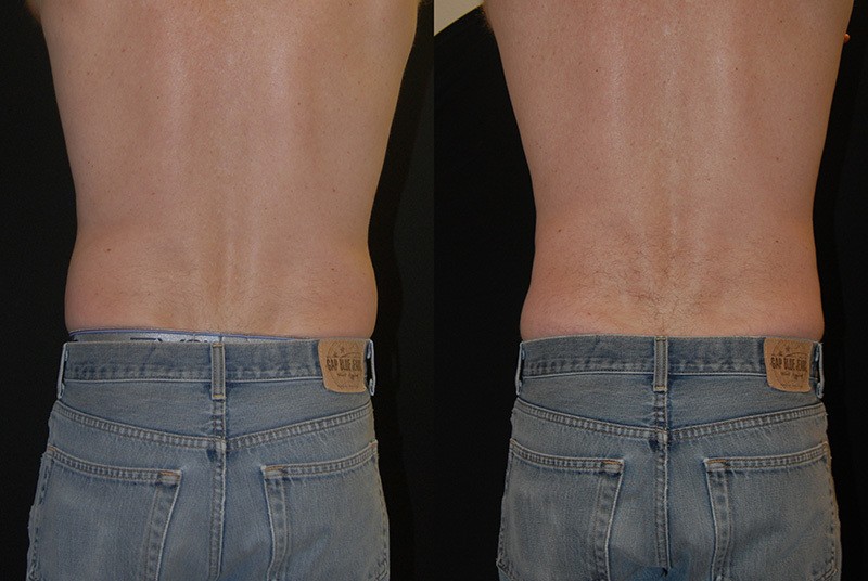 coolsculpting before and after lower back