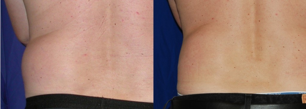 coolsculpting before and after back