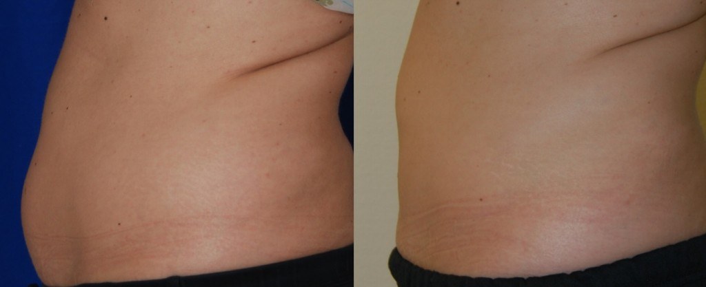 coolsculpting before and after abdominal region