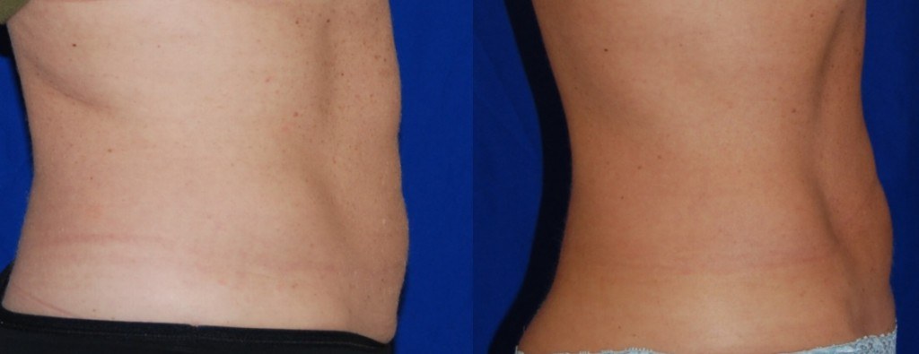 coolsculpting before and after waistline