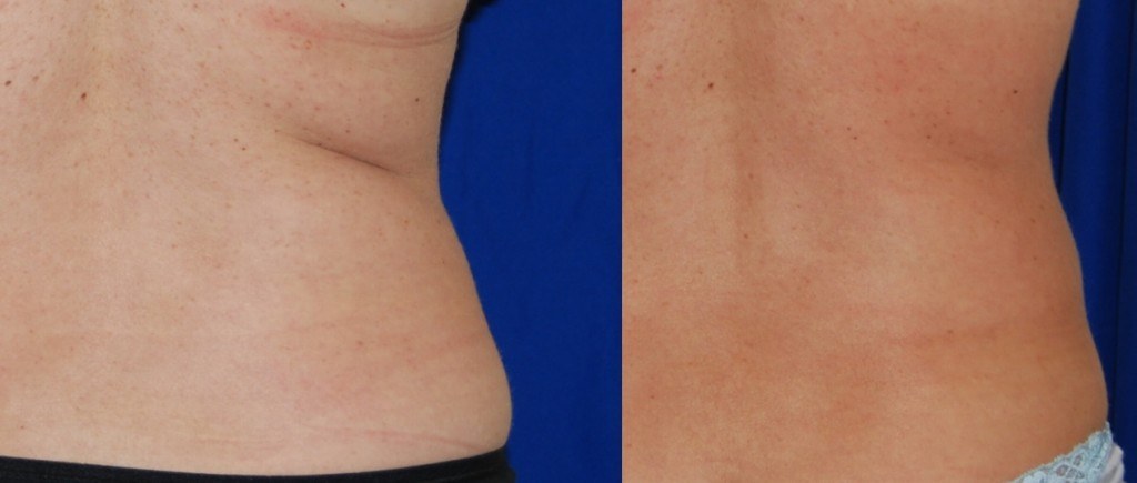 coolsculpting before and after hips