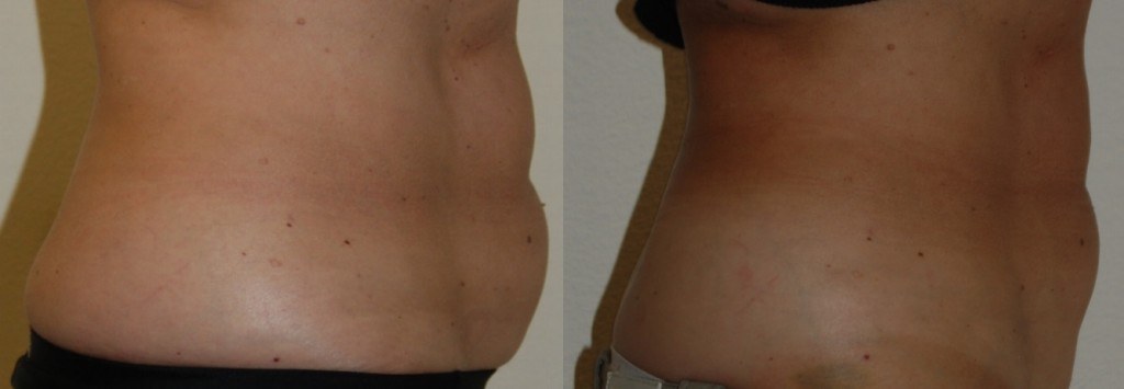 coolsculpting before and after stomach area