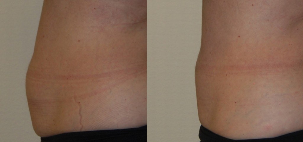 coolsculpting before and after waist