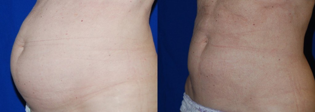 coolsculpting before and after stomach