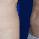 coolsculpting before and after stomach