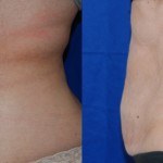 coolsculpting before and after treatment
