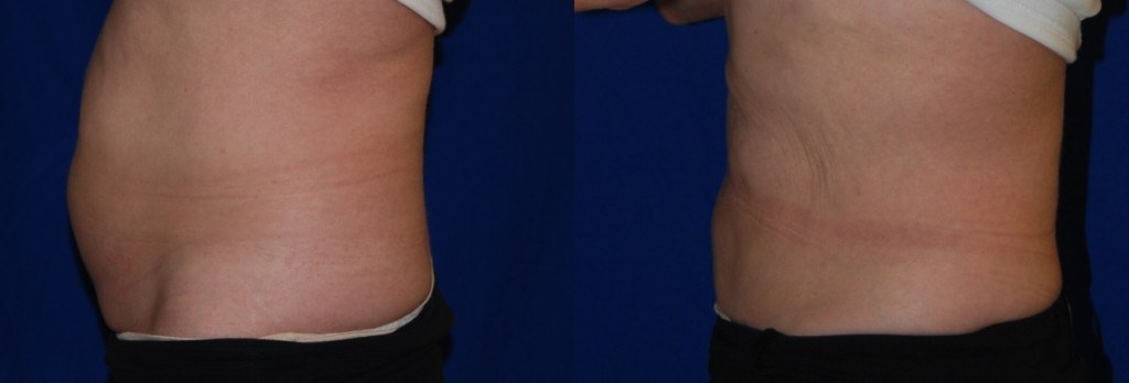 coolsculpting before and after Sonoma County